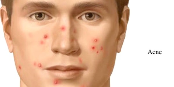 PETUA HILANGKAN JERAWAT