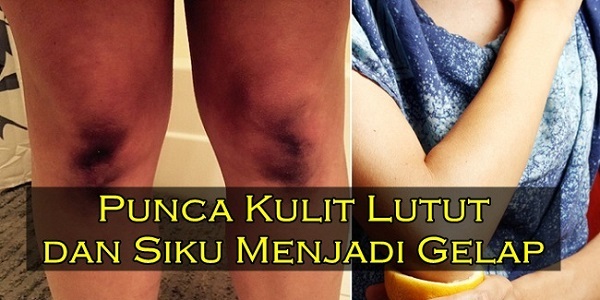 PUNCA MENGAPA KULIT LUTUT DAN SIKU WARNA HITAM.jpg
