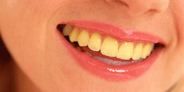 Inilah Minuman Yang Membuatkan Gigi Anda Jadi Kuning