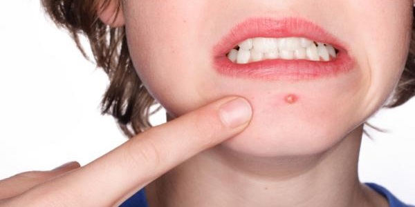 Jauhi 6 Makanan Ini Kalau Nak Kulit Cantik.jpg