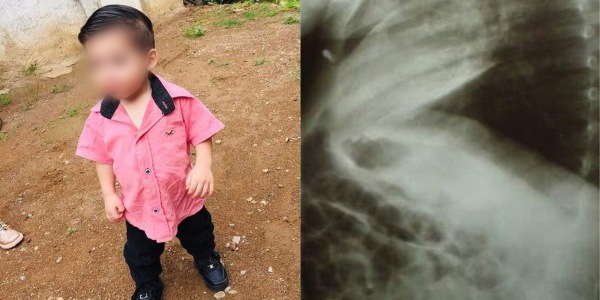 Budak Tertelan Bateri Yang Mɛletup Dalam Badan, Kini Bertarung Ny4wa Di Hospital